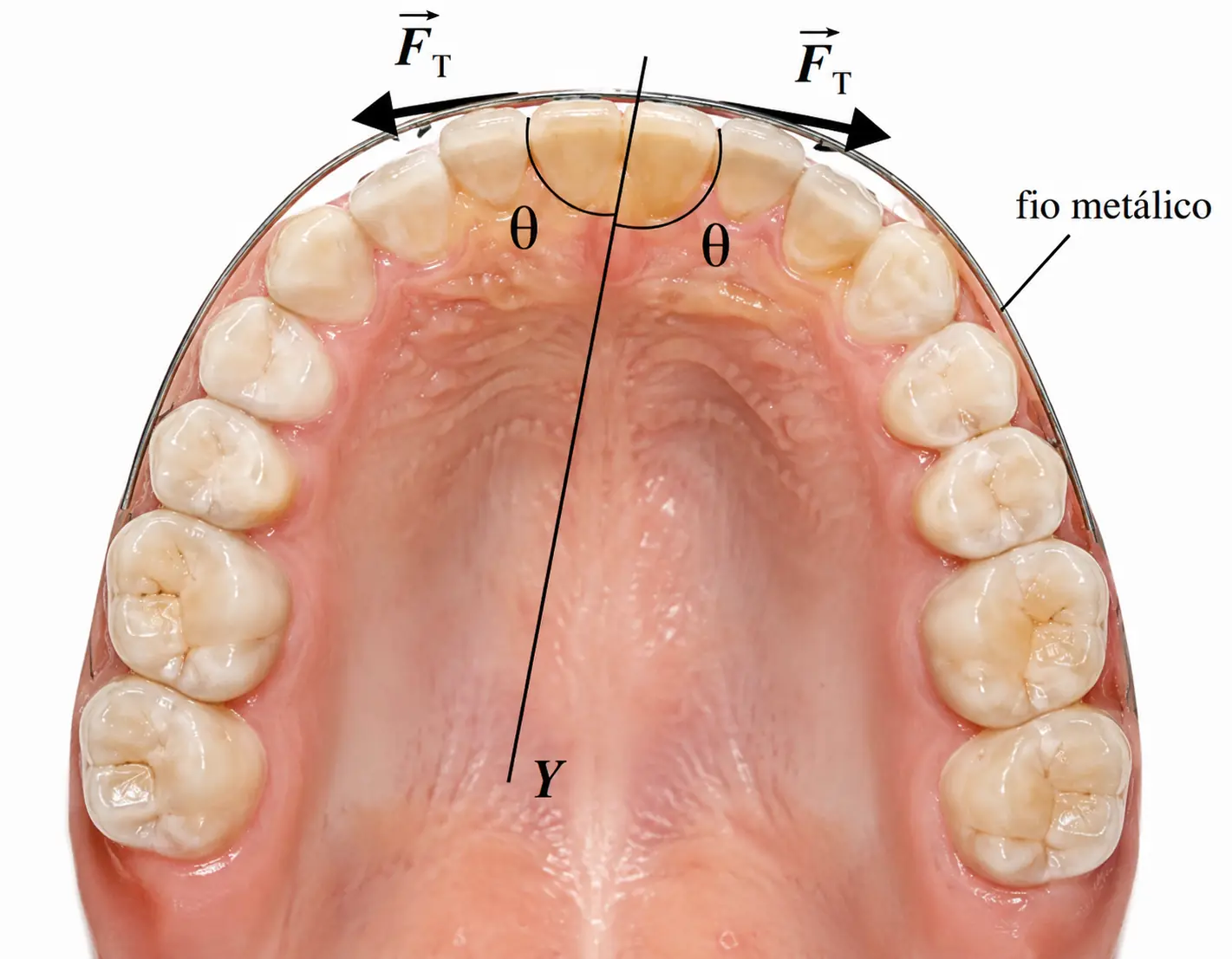 Arcada dentária vista de cima com um fio metálico preso a um dente em destaque; duas forças F_T, simétricas em relação ao eixo y (vertical, alinhado com o dente), partem do dente formando cada uma um ângulo θ com o eixo y.