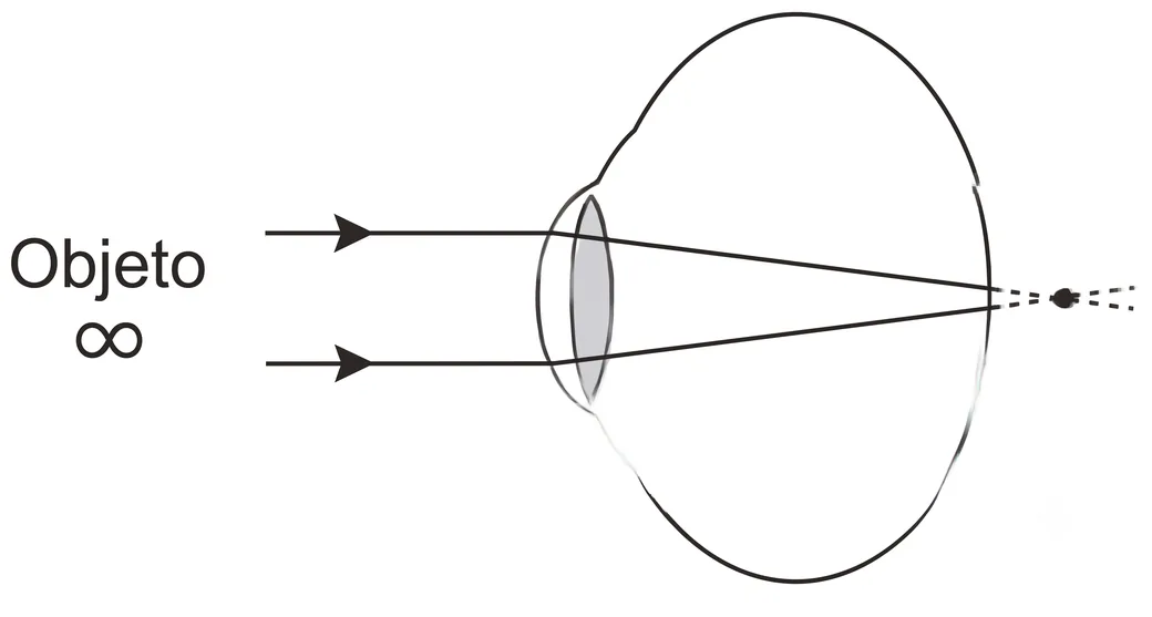 Objeto no infinito, com os raios convergindo exatamente sobre a retina
