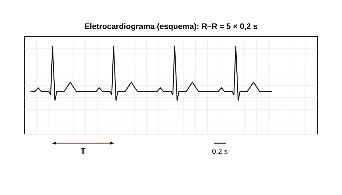 Esquema de um eletrocardiograma normal, com o intervalo entre dois picos consecutivos (período T) igual a cinco divisões de 0,2 s