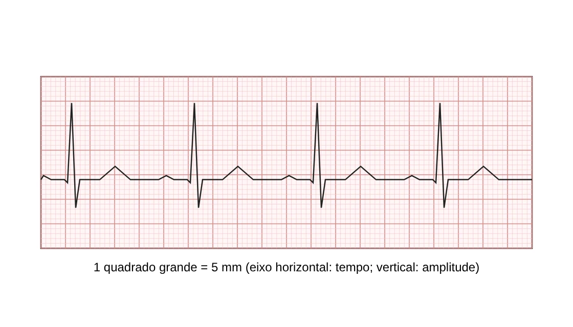 Trecho de eletrocardiograma com quatro batimentos, cada intervalo entre picos R ocupando 5 quadrados grandes da carta