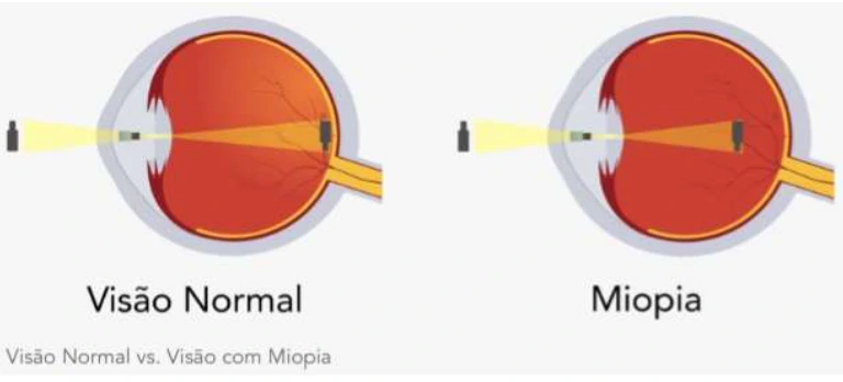 Olho normal forma imagem sobre a retina; olho míope forma a imagem antes da retina.