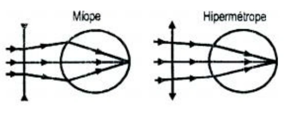 Diagrama de correção: lente divergente antes do olho míope e lente convergente antes do olho hipermétrope fazem os raios convergirem sobre a retina.
