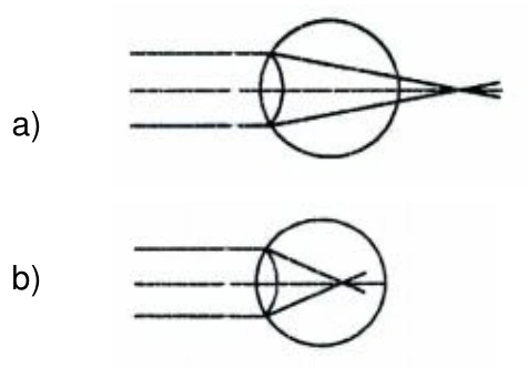 Raios paralelos no olho hipermétrope convergem atrás da retina, caso a; no olho míope convergem antes da retina, caso b.