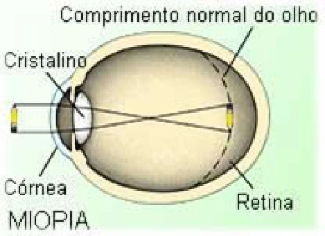 Olho míope, com foco antes da retina.