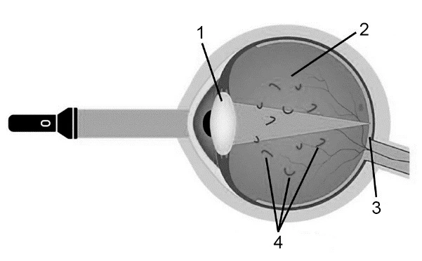 Esquema do olho iluminado: 1 aponta para a lente anterior, 2 para o interior do globo, 3 para a membrana posterior e 4 para fragmentos suspensos no interior.