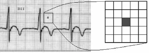 Traçado de eletrocardiograma com picos consecutivos e ampliação de uma malha com 25 quadrados de 1 mm.
