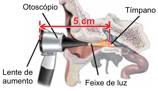 Otoscópio no canal auditivo: lente de aumento a 5 cm do tímpano, com o feixe de luz indicado