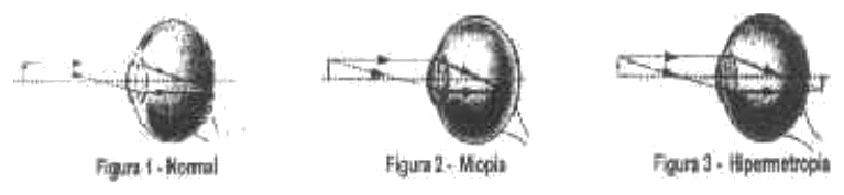 Três olhos em corte, com raios paralelos entrando da esquerda. Figura 1, olho normal: os raios convergem sobre a retina. Figura 2, miopia: os raios convergem antes da retina. Figura 3, hipermetropia: os raios convergiriam depois da retina.