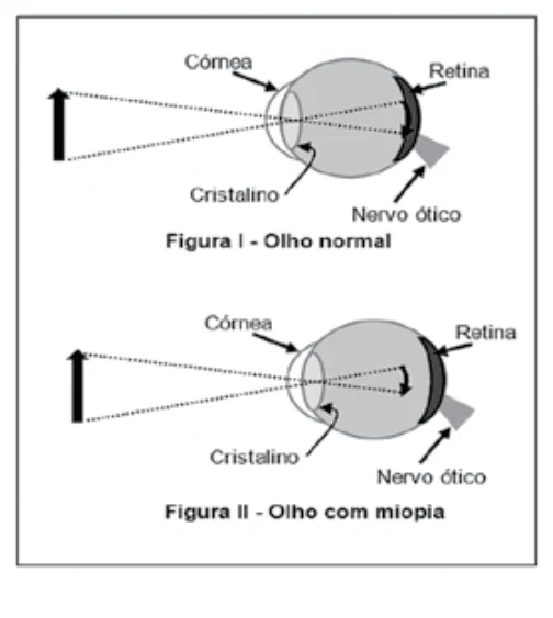 Esquemas de um olho normal e de um olho com miopia, indicando córnea, cristalino, retina e nervo óptico.