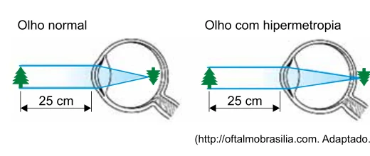 Comparação entre olho normal e olho com hipermetropia