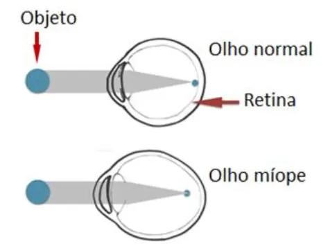 Comparação entre formação de imagem em olho normal e olho míope