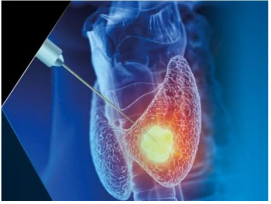 Ilustração de uma tireoide com um tumor aquecido e uma agulha de ablação inserida