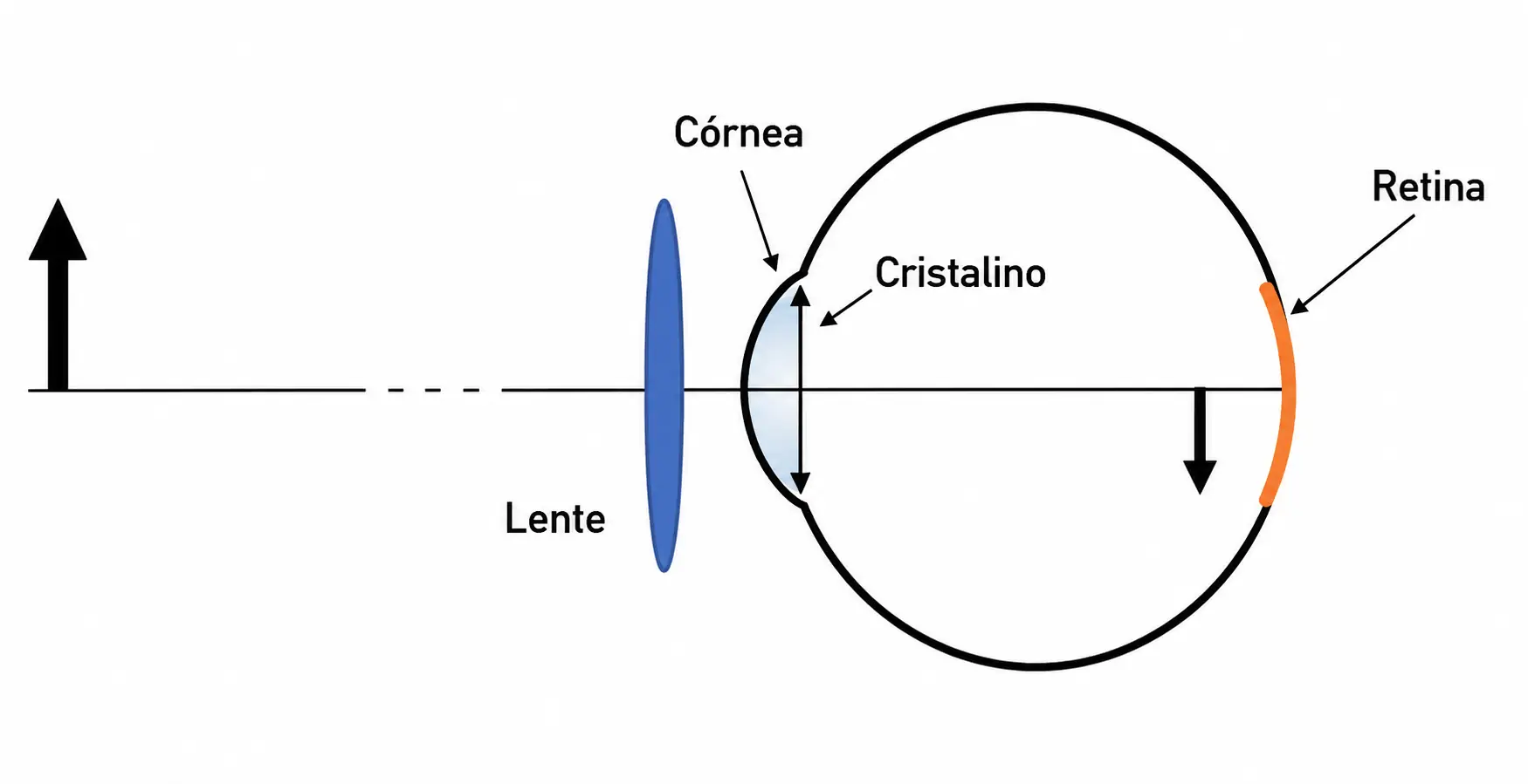Esquema do olho com a lente corretiva posicionada antes da córnea, mostrando os raios de luz do objeto formando a imagem invertida sobre a retina, com córnea, cristalino e retina identificados