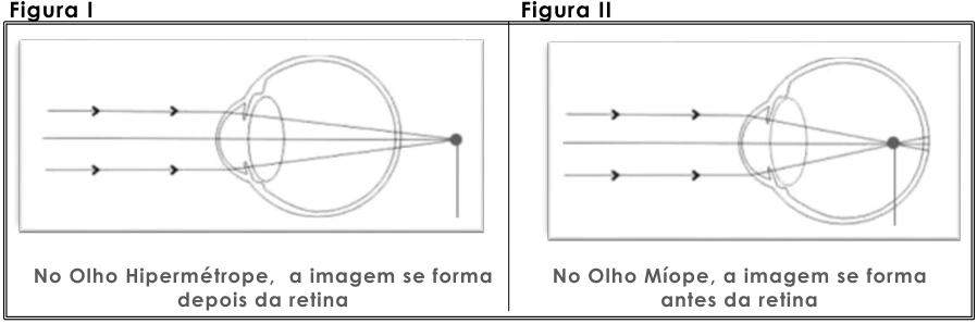 Figura I: imagem após a retina no olho hipermétrope. Figura II: imagem antes da retina no olho míope.