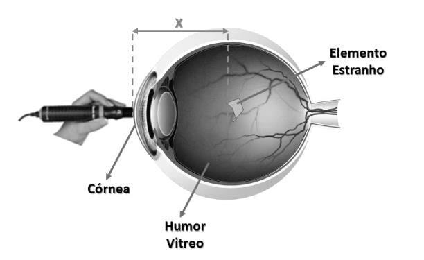 Percurso do ultrassom entre a córnea e o elemento no humor vítreo.