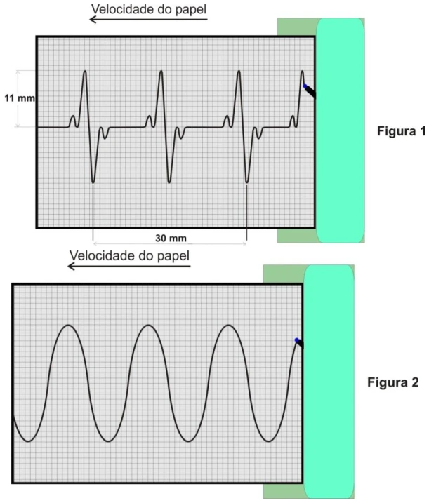 Escala temporal no ECG: esquema original da questão 29 da UFSC 2019.2