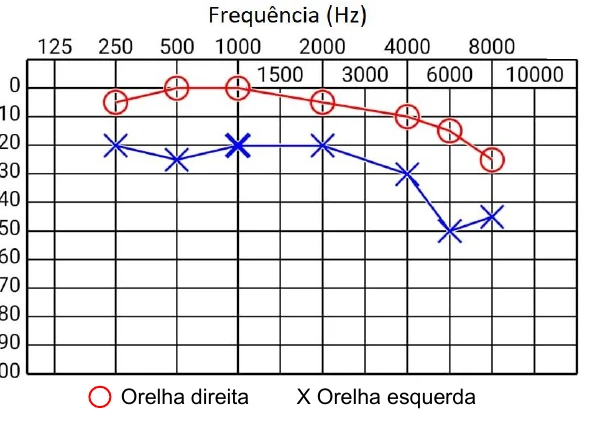 Audiograma: a orelha direita, marcada com círculos, tem limiares entre 0 e 25 dB; a orelha esquerda, marcada com X, tem limiares entre 20 e 50 dB