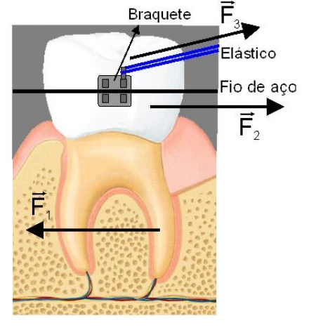 Dente com braquete, fio de aço e elástico, com os vetores das forças aplicadas