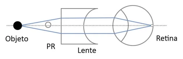 Arranjo A — correção óptica do olho míope com lente prescrita