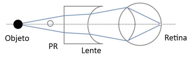 Arranjo B — correção óptica do olho míope com lente prescrita