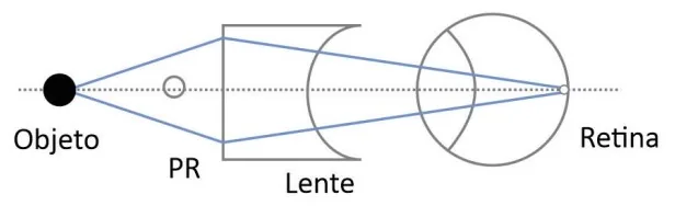 Arranjo C — correção óptica do olho míope com lente prescrita