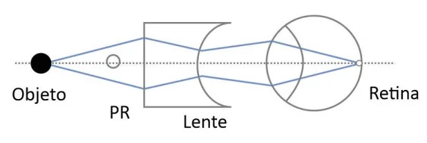 Arranjo D — correção óptica do olho míope com lente prescrita