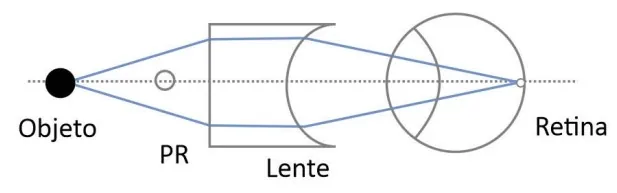 Arranjo E — correção óptica do olho míope com lente prescrita