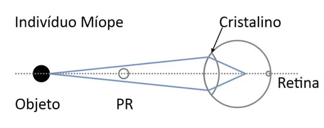 Esquema do olho míope com ponto remoto e imagem formada à frente da retina