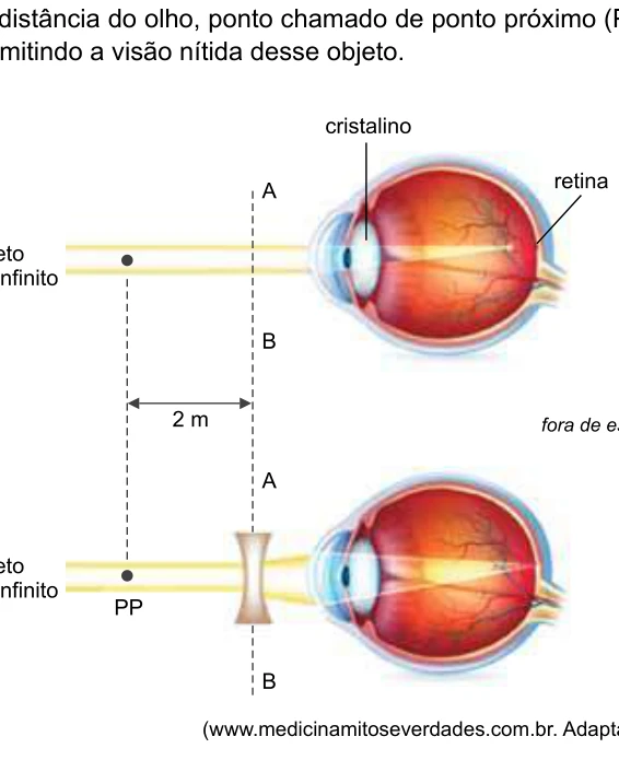Lente divergente diante do olho míope forma imagem virtual a 2 metros; caderno usa a sigla PP para esse limite distante.