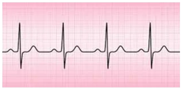 Onda exibindo padrão cardiológico pulsante no papel quadriculado listando 4 picos R salientes sequenciais espaçados.