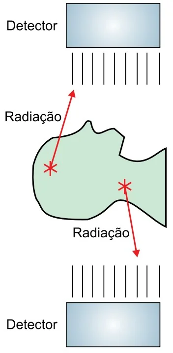 Esquema da medicina nuclear exibindo detectores acima e abaixo do paciente captando irradiação fóton gerada internamente.