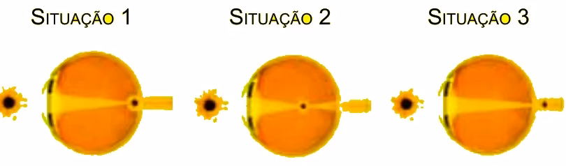Três diagramas de formação de imagem no olho humano: foco na retina, antes da retina e depois da retina