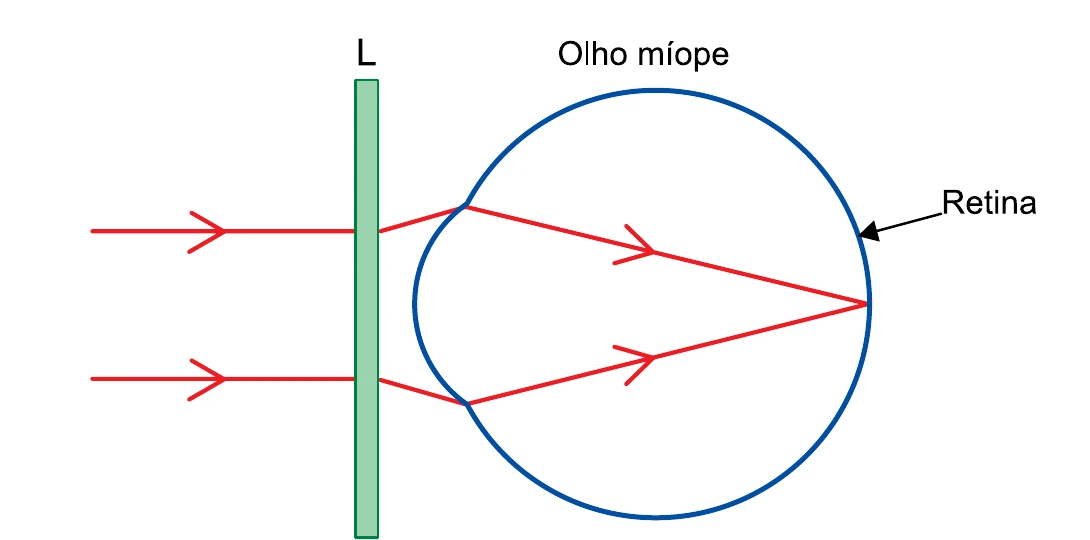 Olho míope com lente corretiva L diante do olho e raios convergindo para a retina