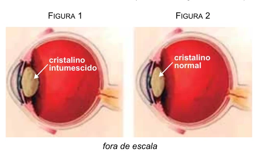 Comparação entre cristalino intumescido e cristalino normal