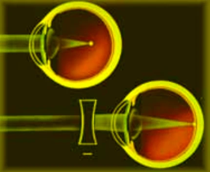 Dois olhos: no superior, sem lente, os raios convergem antes da retina; no inferior, uma lente bicôncava colocada diante do olho faz a imagem se formar sobre a retina