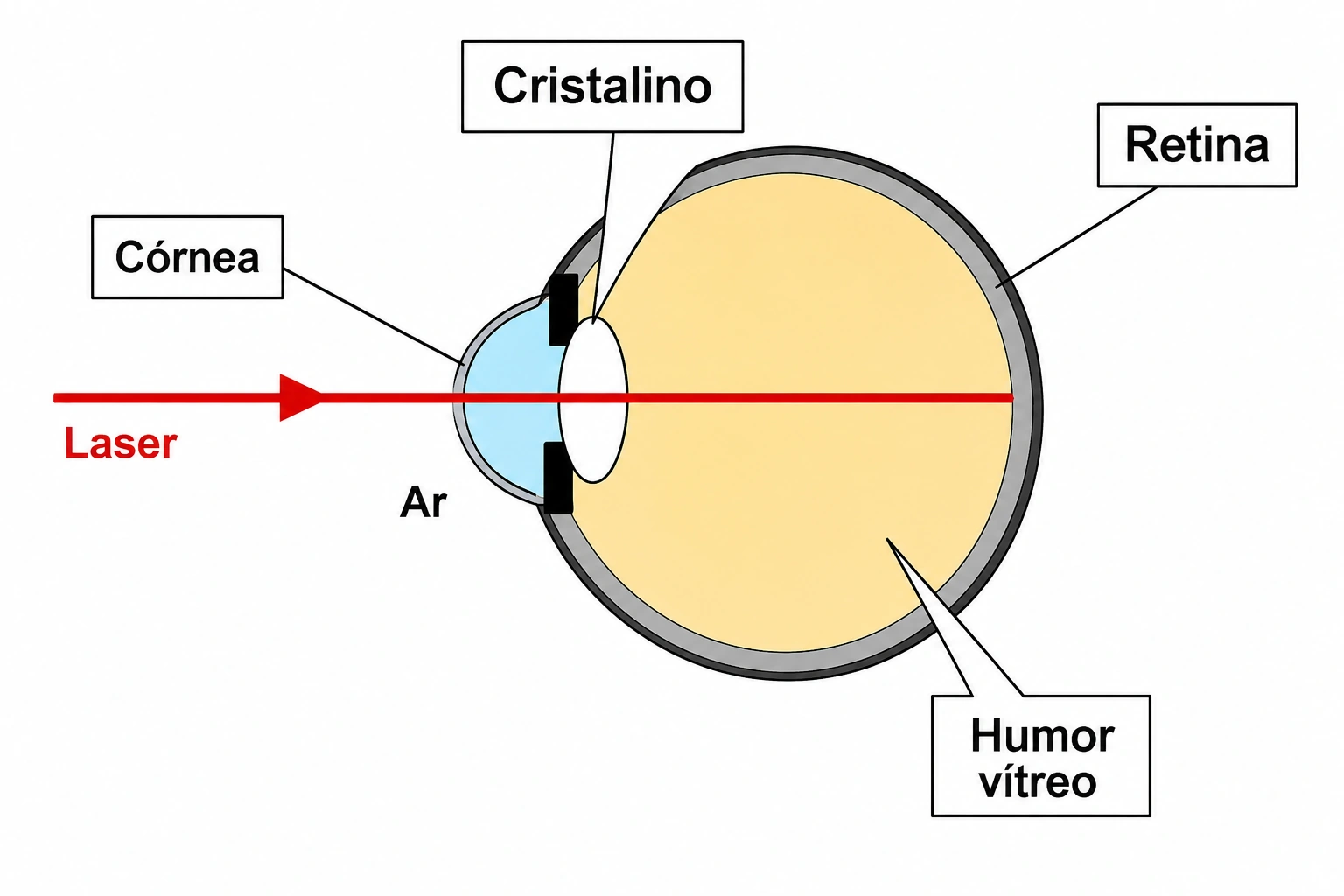 Corte esquemático do olho humano mostrando um laser atravessando a córnea, o ar, o cristalino e o humor vítreo até atingir a retina